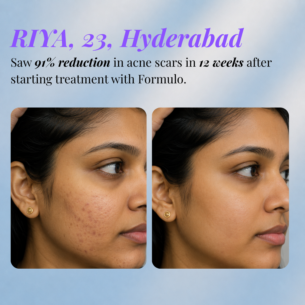 Acne Scar Treatment Kit
