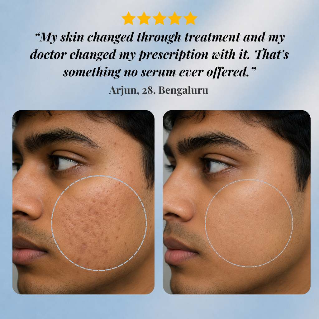 Acne Scar Treatment Kit