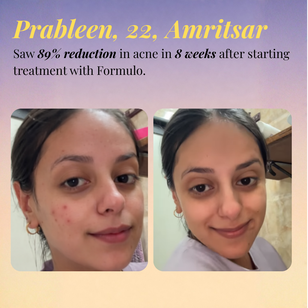 Oily Skin Acne Treatment Kit