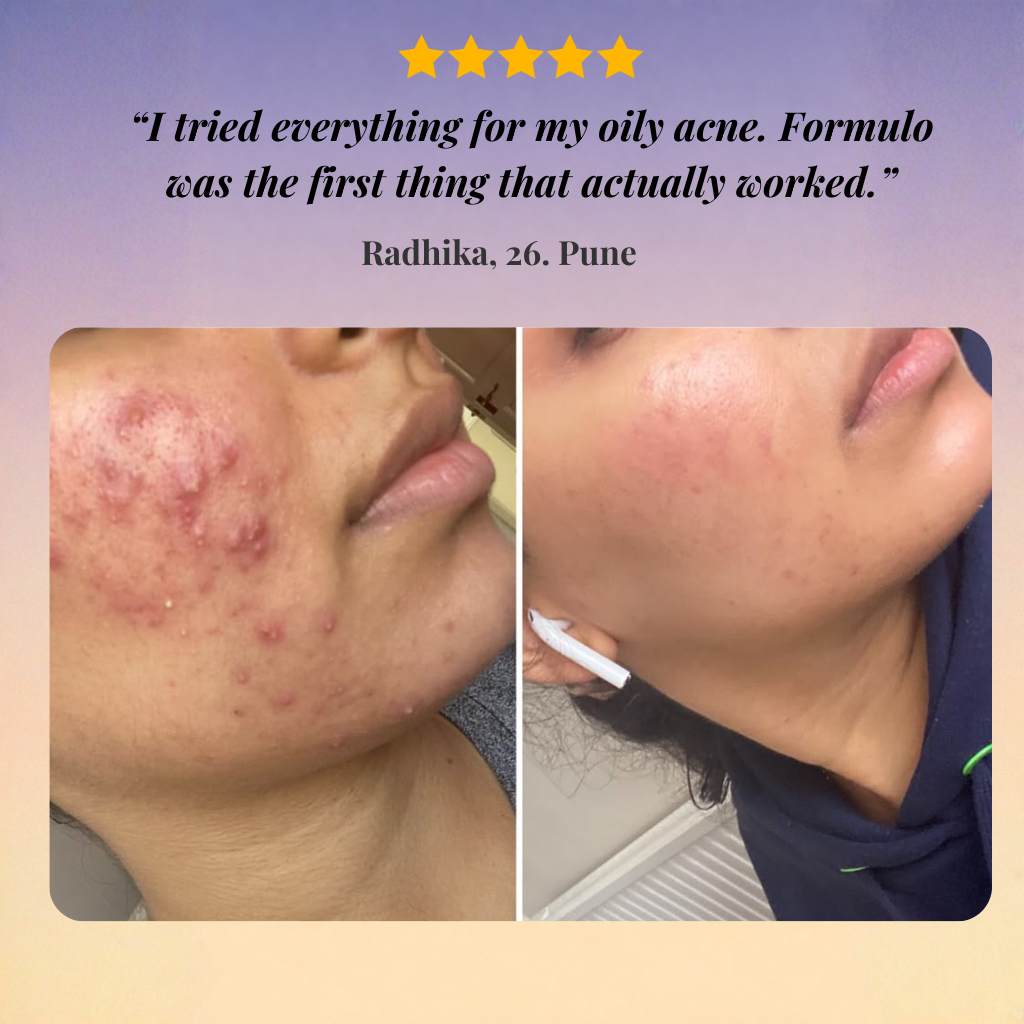 Oily Skin Acne Treatment Kit