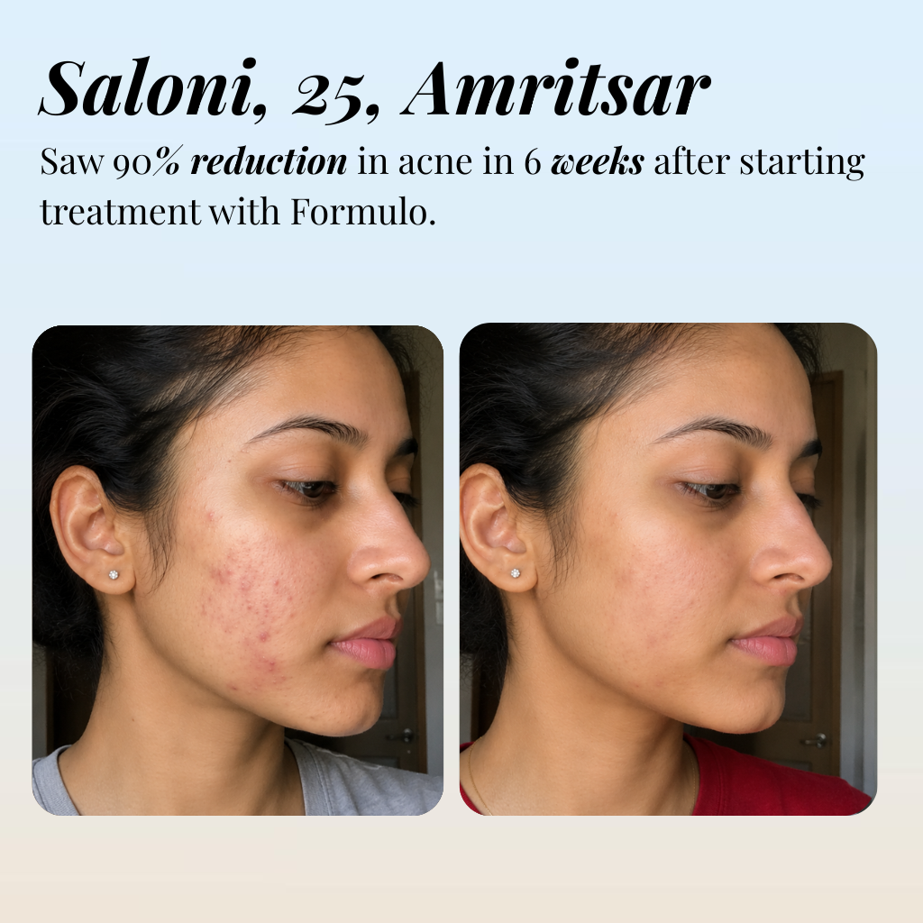 Combination Acne Skin Treatment