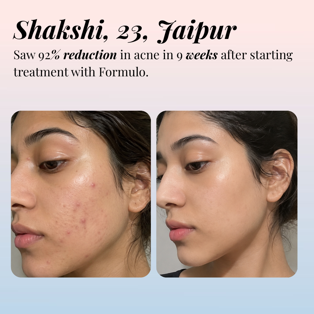Acne Treatment for Dry Skin