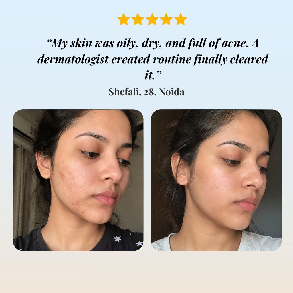 Combination Acne Skin Treatment
