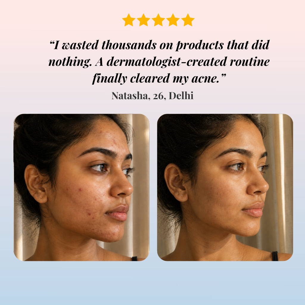Acne Treatment for Dry Skin