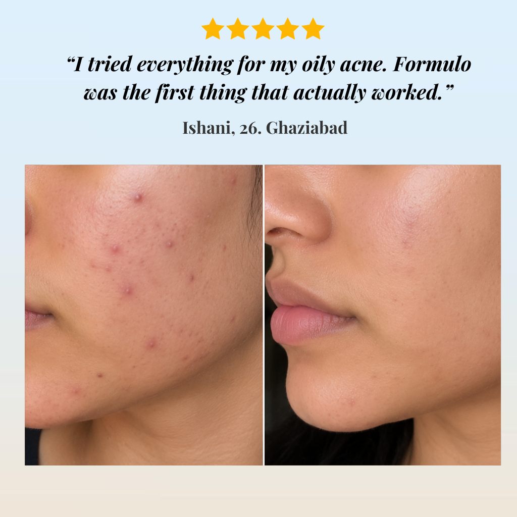 Combination Acne Skin Treatment