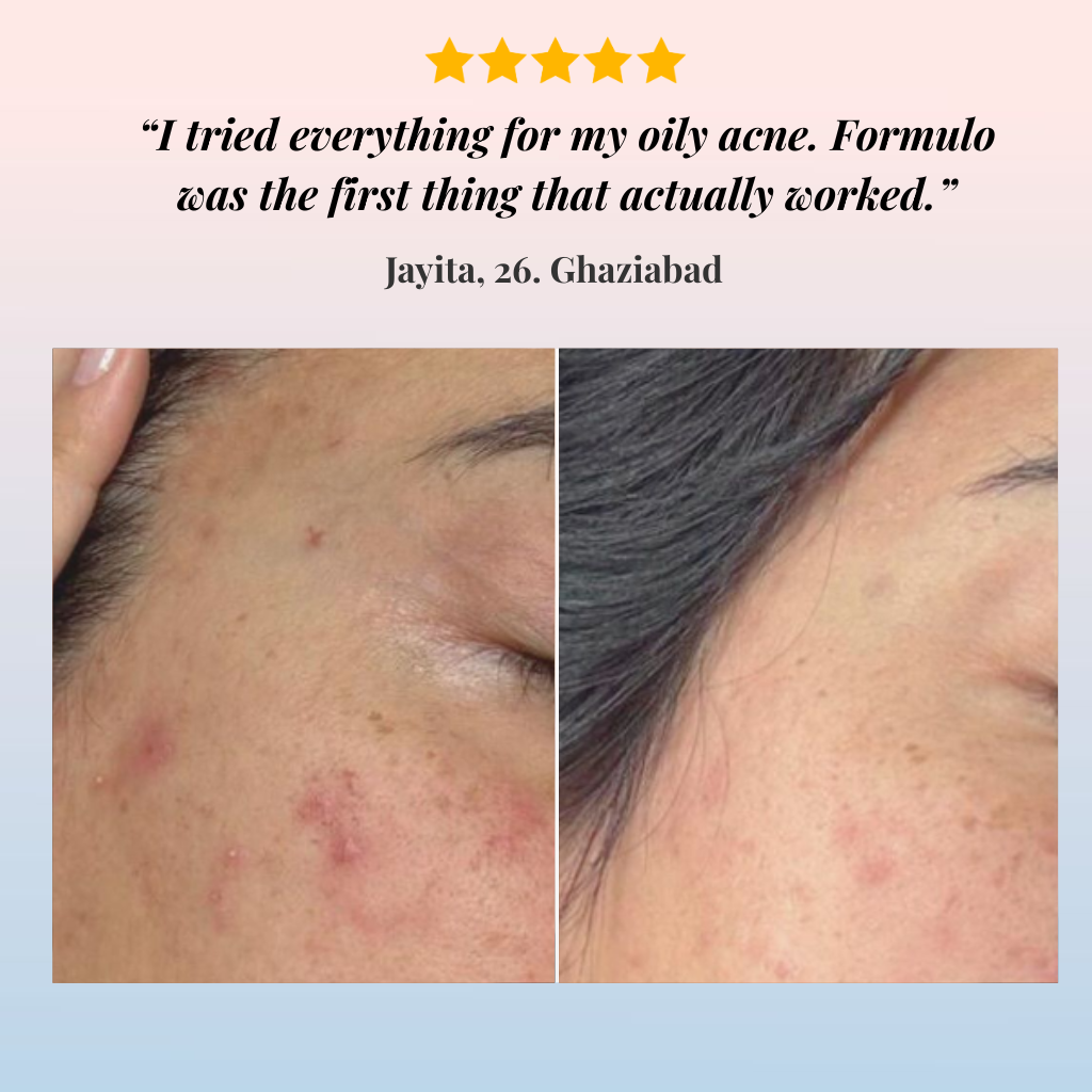 Acne Treatment for Dry Skin